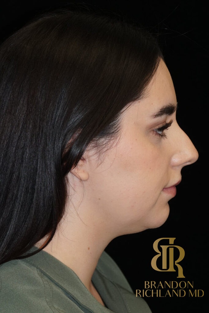 Chin Liposuction Before, Patient 10, view 3 — Dr. Brandon Richland, Newport Beach