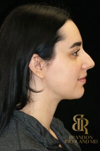 Chin Liposuction before and after, Patient 10 — Dr. Brandon Richland, Newport Beach