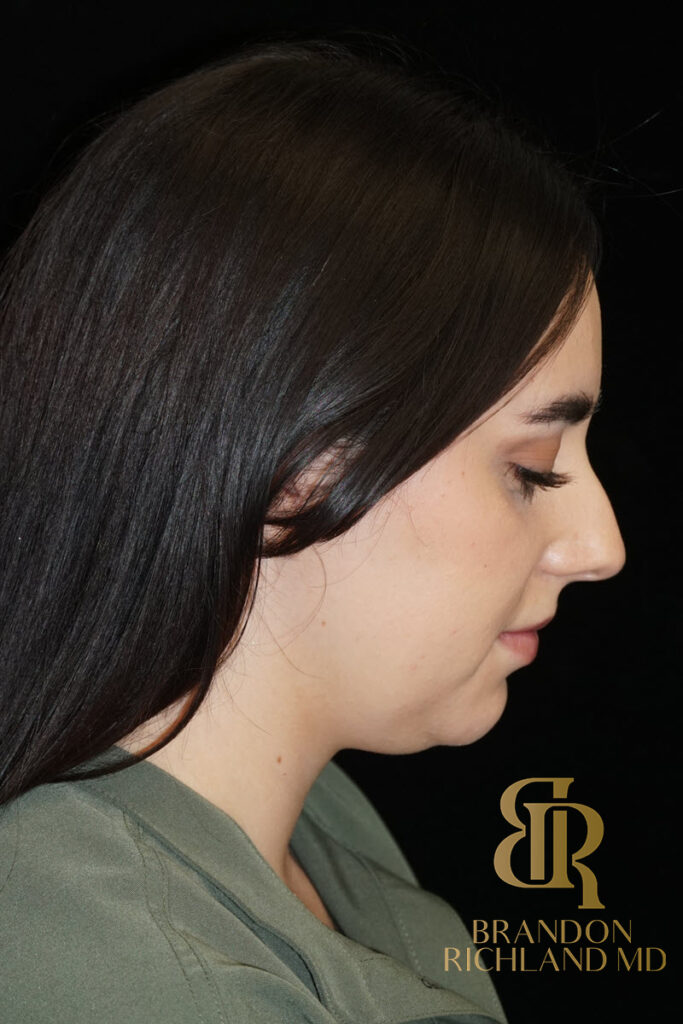 Chin Liposuction Before, Patient 10, view 4 — Dr. Brandon Richland, Newport Beach