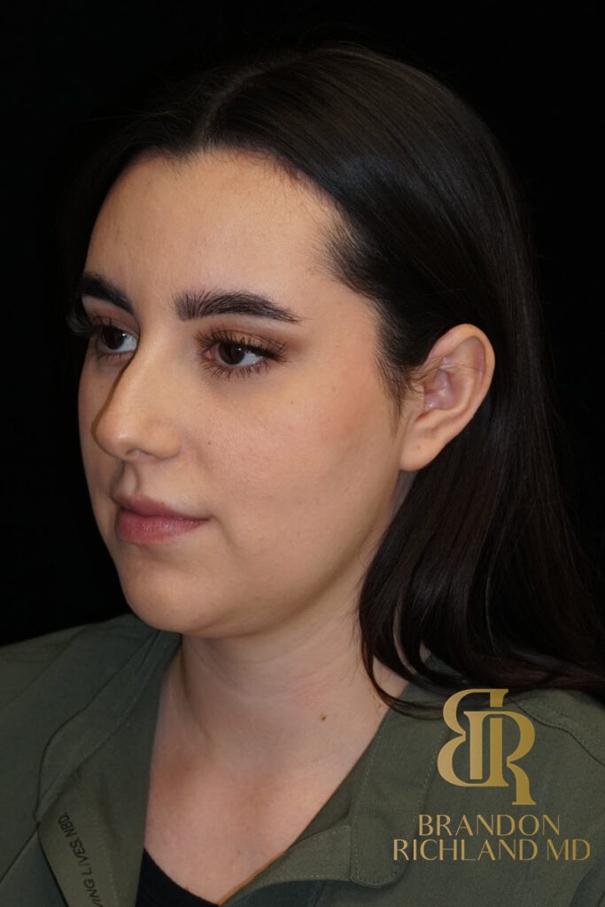 Chin Liposuction Before, Patient 10, view 5 — Dr. Brandon Richland, Newport Beach