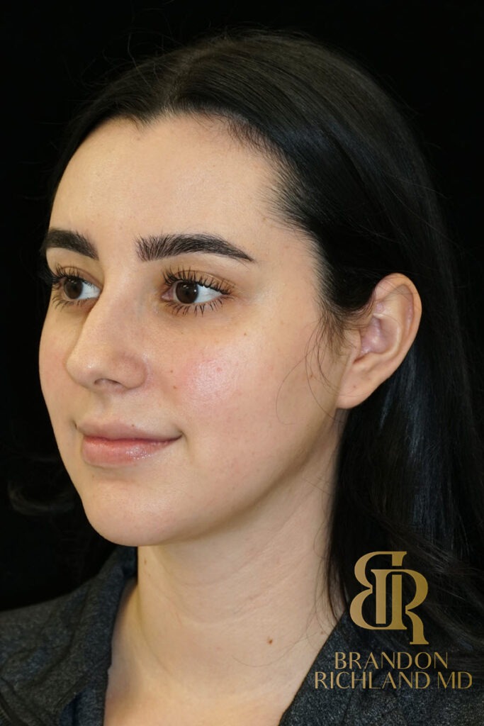 Chin Liposuction After, Patient 10, view 5 — Dr. Brandon Richland, Newport Beach
