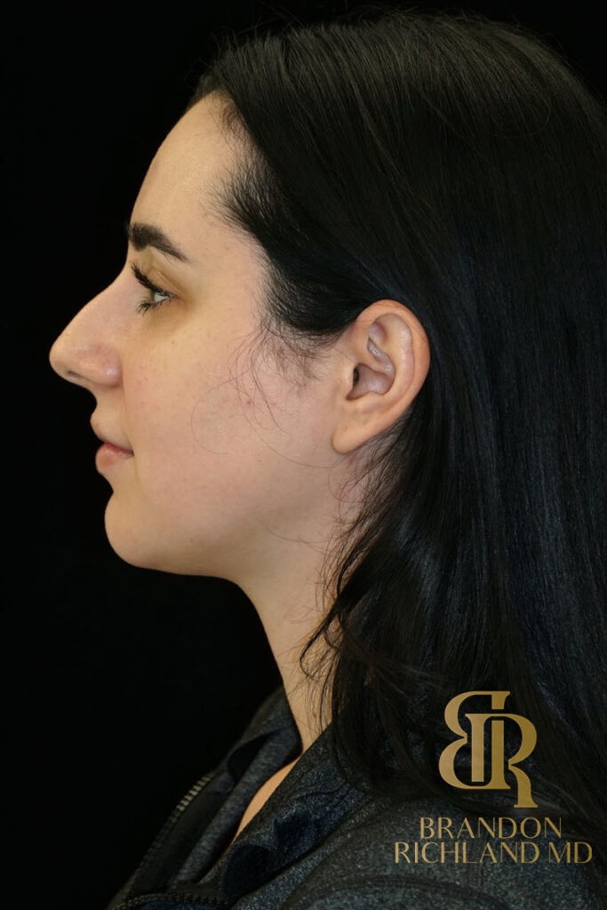 Chin Liposuction After, Patient 10, view 6 — Dr. Brandon Richland, Newport Beach