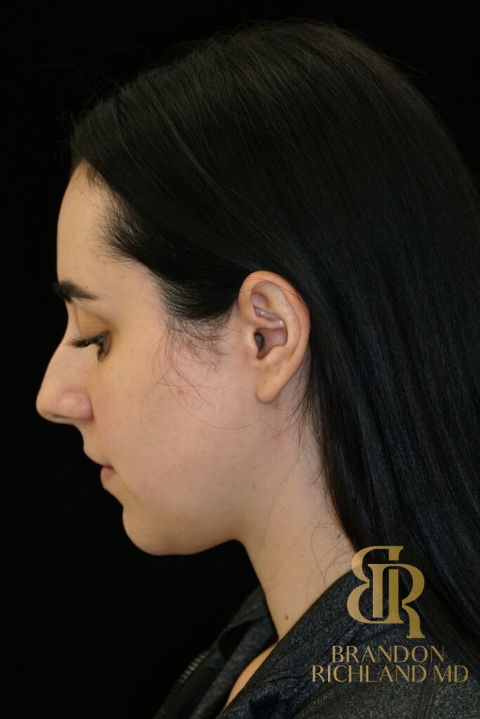 Chin Liposuction After, Patient 10, view 7 — Dr. Brandon Richland, Newport Beach