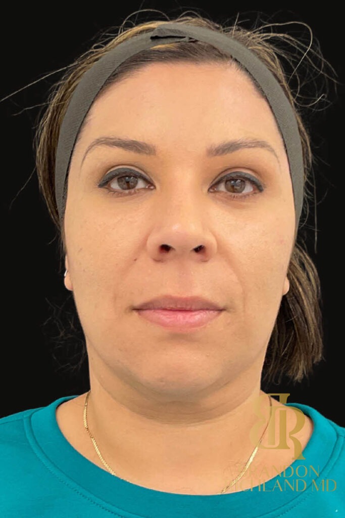 Chin Liposuction Before, Patient 11, view 1 — Dr. Brandon Richland, Newport Beach