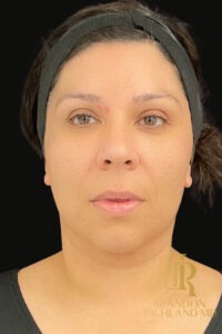 Chin Liposuction before and after, Patient 11 — Dr. Brandon Richland, Newport Beach