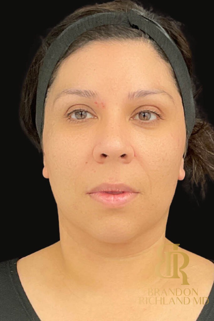 Chin Liposuction After, Patient 11, view 1 — Dr. Brandon Richland, Newport Beach