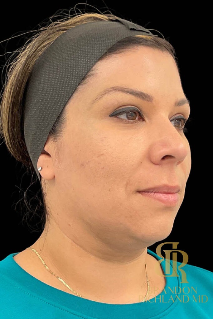Chin Liposuction Before, Patient 11, view 2 — Dr. Brandon Richland, Newport Beach