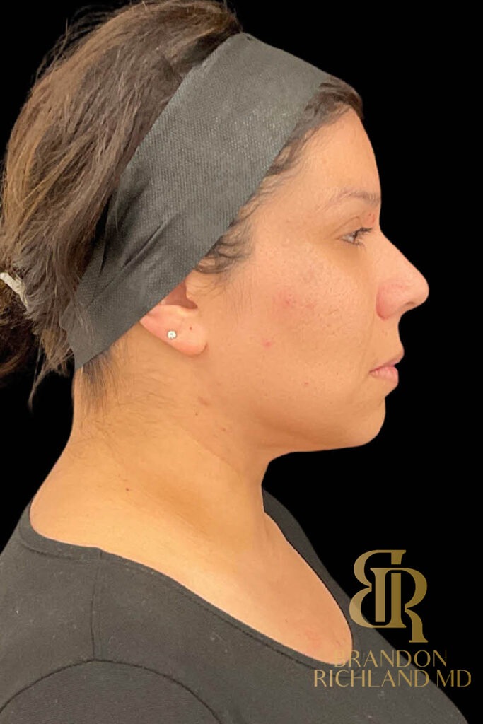 Chin Liposuction After, Patient 11, view 3 — Dr. Brandon Richland, Newport Beach