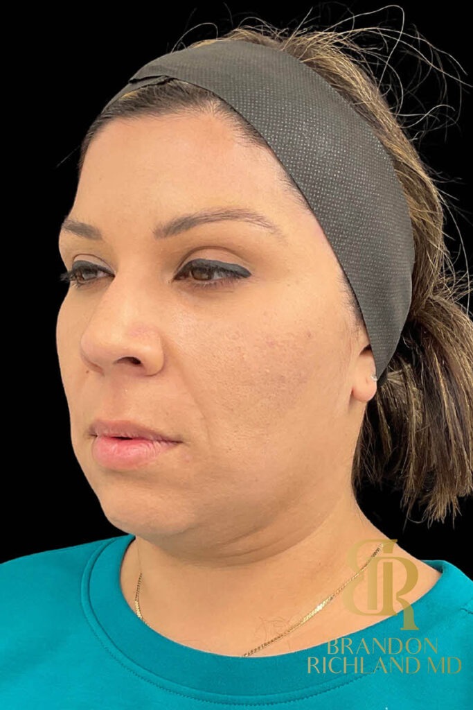 Chin Liposuction Before, Patient 11, view 4 — Dr. Brandon Richland, Newport Beach