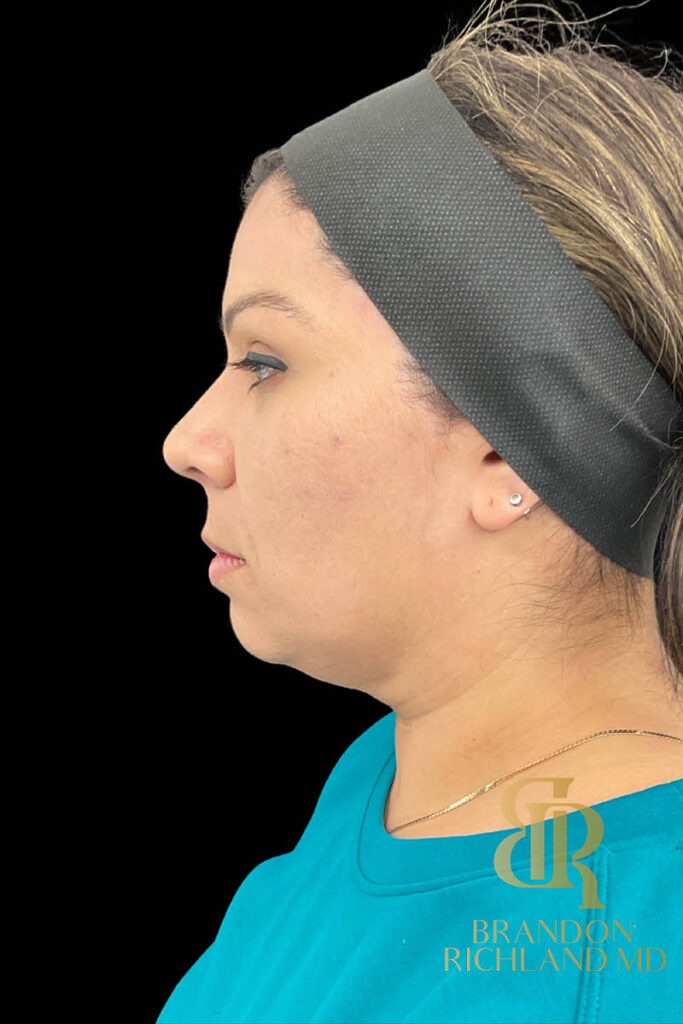 Chin Liposuction Before, Patient 11, view 5 — Dr. Brandon Richland, Newport Beach