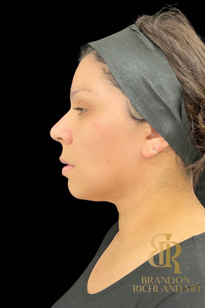Chin Liposuction After, Patient 11, view 5 — Dr. Brandon Richland, Newport Beach