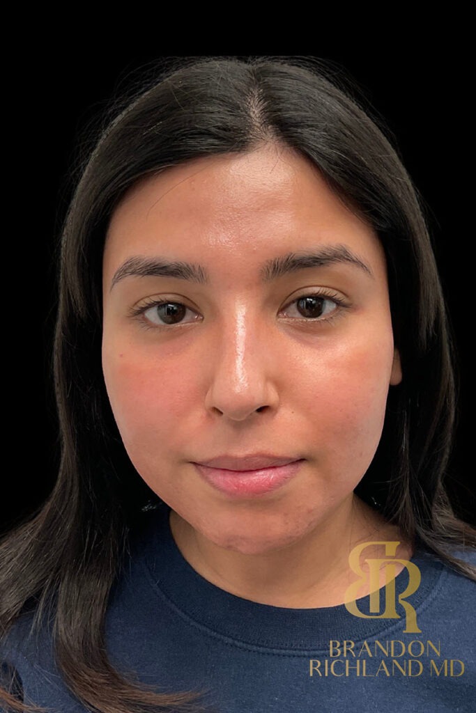 Chin Liposuction Before, Patient 12, view 1 — Dr. Brandon Richland, Newport Beach
