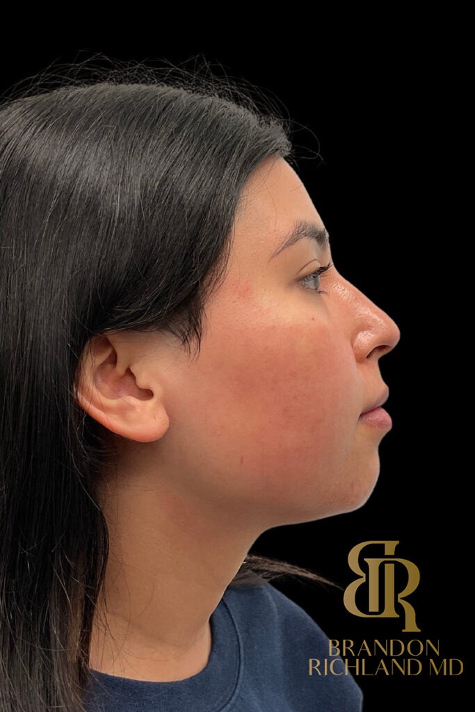 Chin Liposuction Before, Patient 12, view 2 — Dr. Brandon Richland, Newport Beach