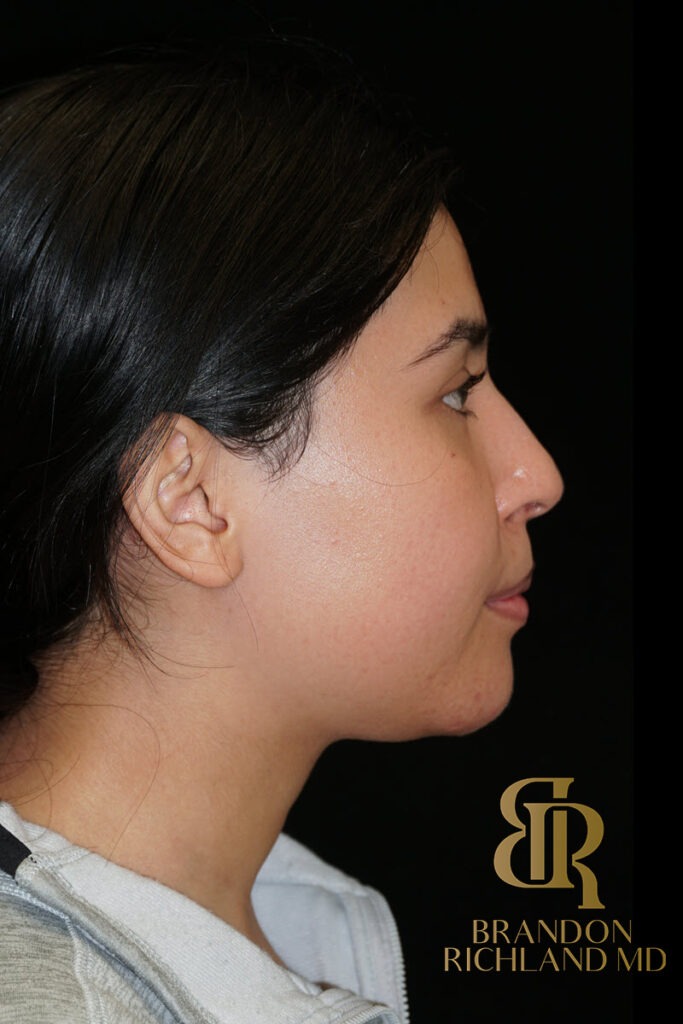 Chin Liposuction After, Patient 12, view 2 — Dr. Brandon Richland, Newport Beach
