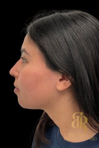 Chin Liposuction before and after, Patient 12 — Dr. Brandon Richland, Newport Beach