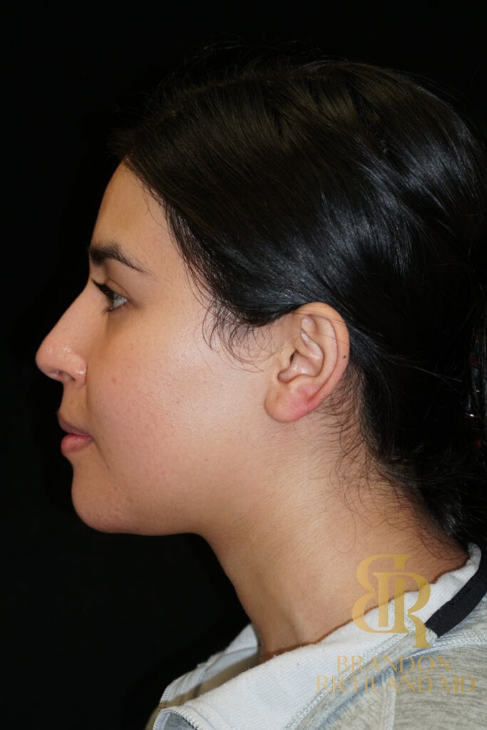 Chin Liposuction After, Patient 12, view 3 — Dr. Brandon Richland, Newport Beach