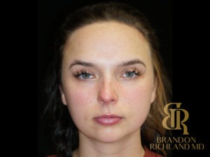 Chin Liposuction before and after, Patient 13 — Dr. Brandon Richland, Newport Beach