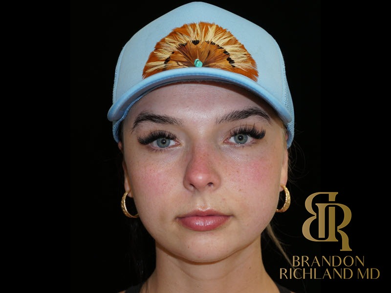 Chin Liposuction After, Patient 13, view 1 — Dr. Brandon Richland, Newport Beach