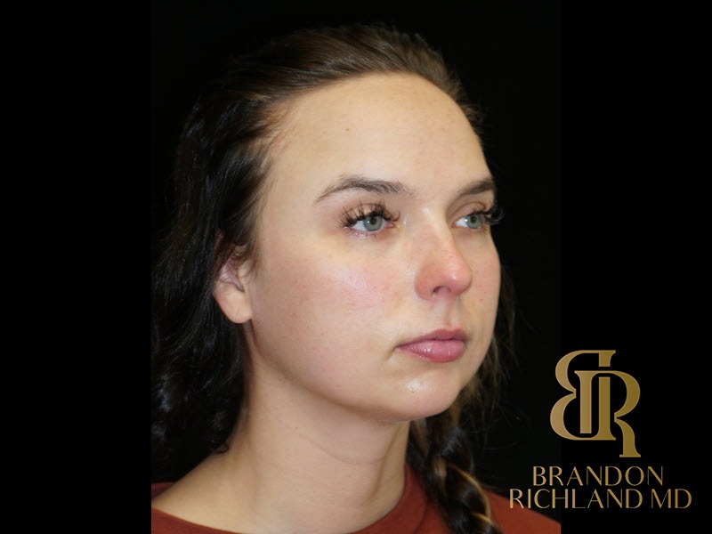 Chin Liposuction Before, Patient 13, view 2 — Dr. Brandon Richland, Newport Beach