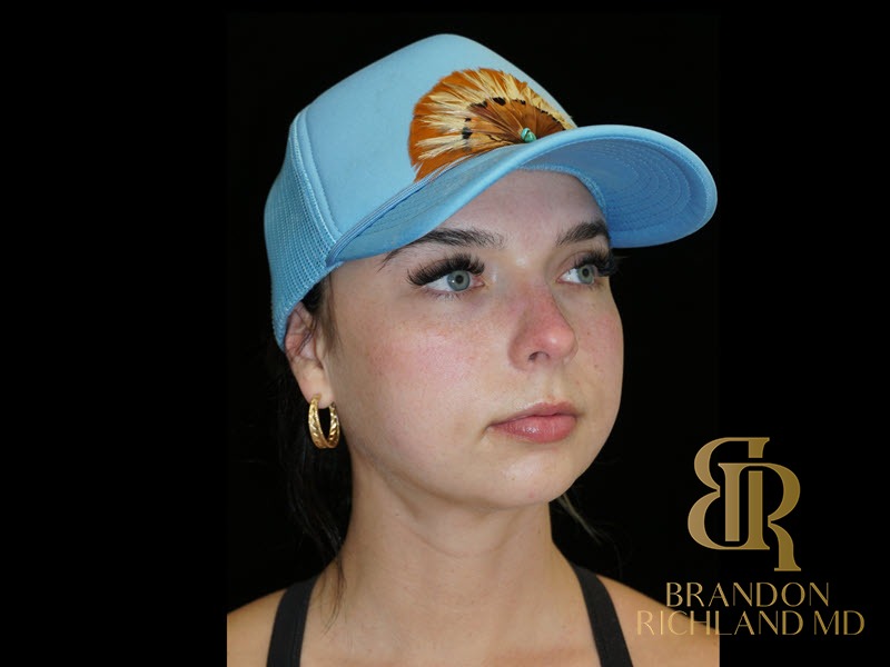 Chin Liposuction After, Patient 13, view 2 — Dr. Brandon Richland, Newport Beach