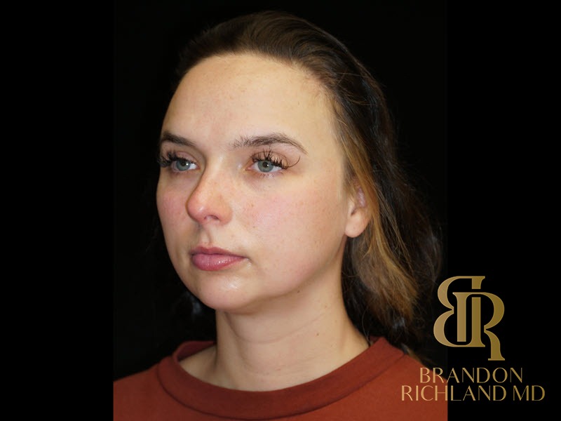 Chin Liposuction Before, Patient 13, view 4 — Dr. Brandon Richland, Newport Beach