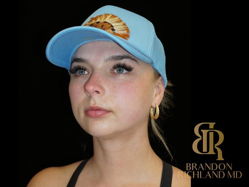 Chin Liposuction After, Patient 13, view 4 — Dr. Brandon Richland, Newport Beach