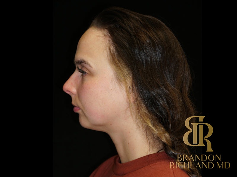 Chin Liposuction Before, Patient 13, view 5 — Dr. Brandon Richland, Newport Beach