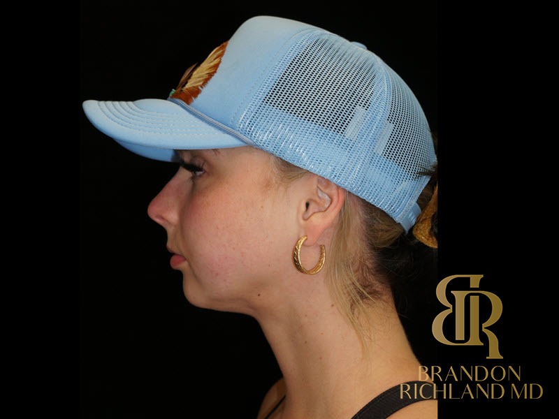 Chin Liposuction After, Patient 13, view 5 — Dr. Brandon Richland, Newport Beach