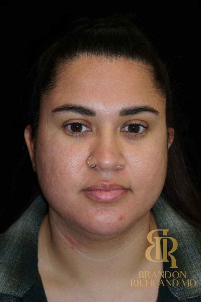 Chin Liposuction Before, Patient 14, view 1 — Dr. Brandon Richland, Newport Beach