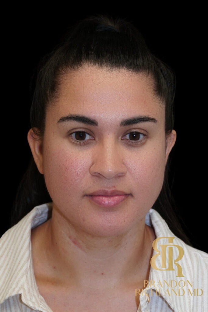 Chin Liposuction After, Patient 14, view 1 — Dr. Brandon Richland, Newport Beach