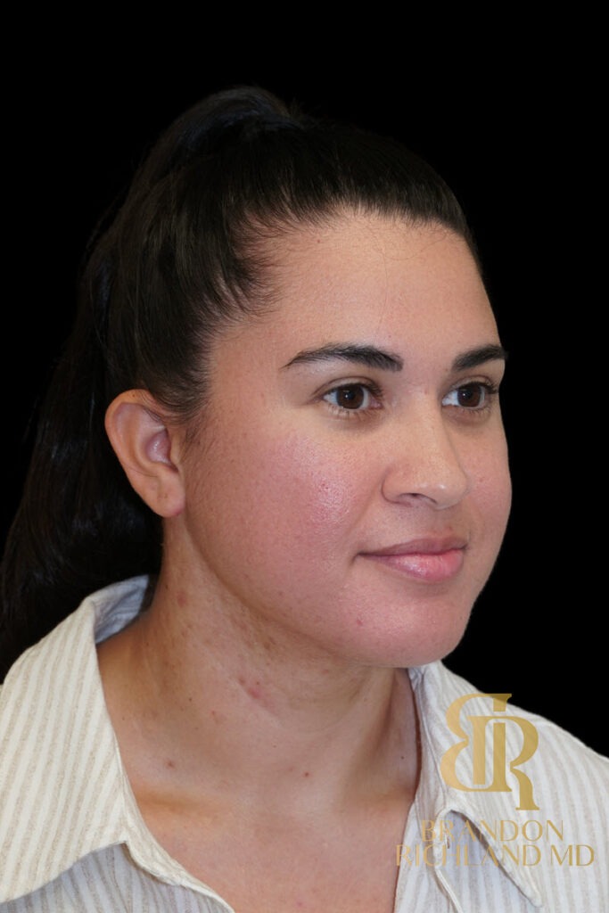 Chin Liposuction After, Patient 14, view 2 — Dr. Brandon Richland, Newport Beach