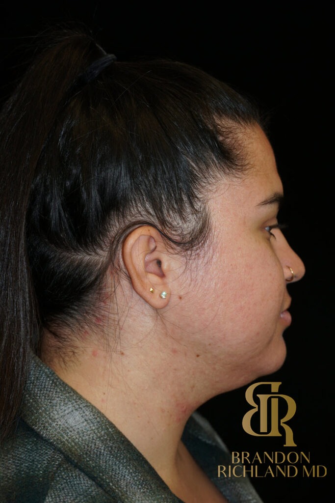 Chin Liposuction Before, Patient 14, view 3 — Dr. Brandon Richland, Newport Beach