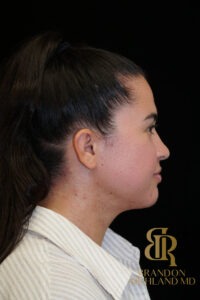 Chin Liposuction before and after, Patient 14 — Dr. Brandon Richland, Newport Beach