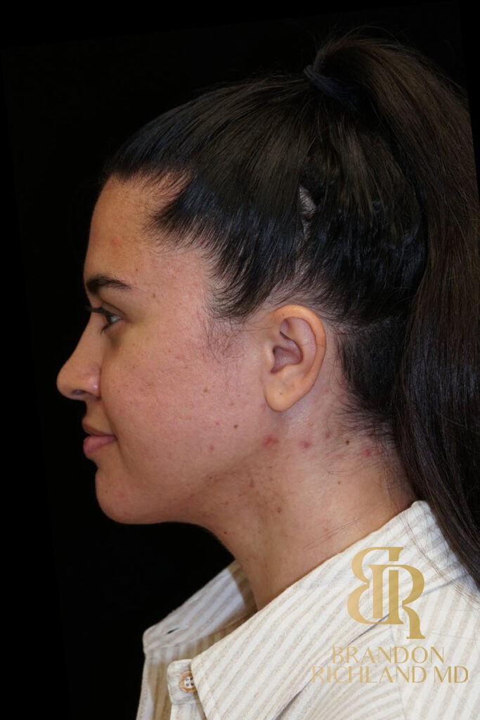 Chin Liposuction After, Patient 14, view 5 — Dr. Brandon Richland, Newport Beach