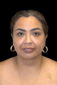 Chin Liposuction before and after, Case #78890 — Dr. Brandon Richland, Newport Beach