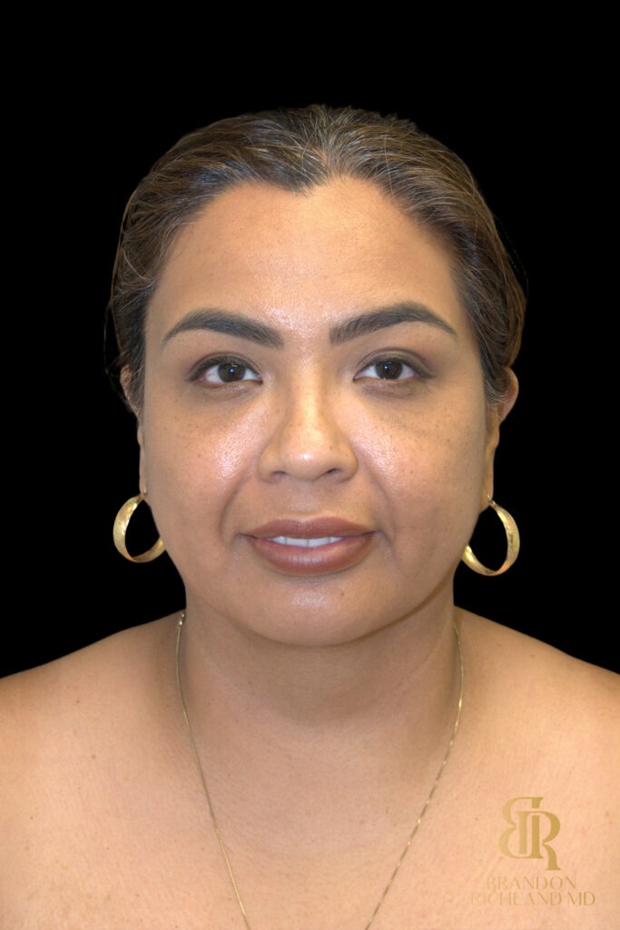 Chin Liposuction After, Case #78890, view 1 — Dr. Brandon Richland, Newport Beach