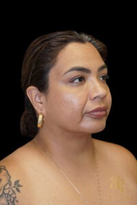 Chin Liposuction before and after, Case #78890 — Dr. Brandon Richland, Newport Beach