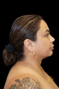 Chin Liposuction before and after, Case #78890 — Dr. Brandon Richland, Newport Beach