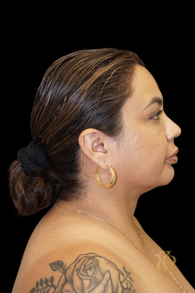 Chin Liposuction After, Case #78890, view 3 — Dr. Brandon Richland, Newport Beach