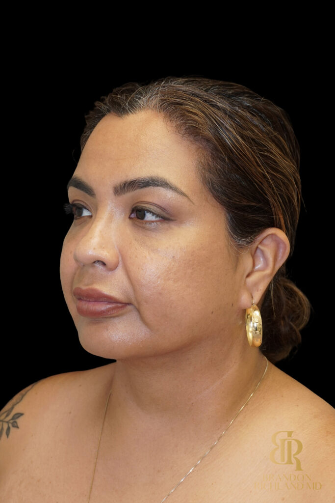 Chin Liposuction After, Case #78890, view 4 — Dr. Brandon Richland, Newport Beach