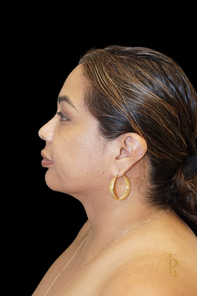 Chin Liposuction After, Case #78890, view 5 — Dr. Brandon Richland, Newport Beach