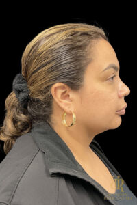 Chin Liposuction before and after, Case #78890 — Dr. Brandon Richland, Newport Beach