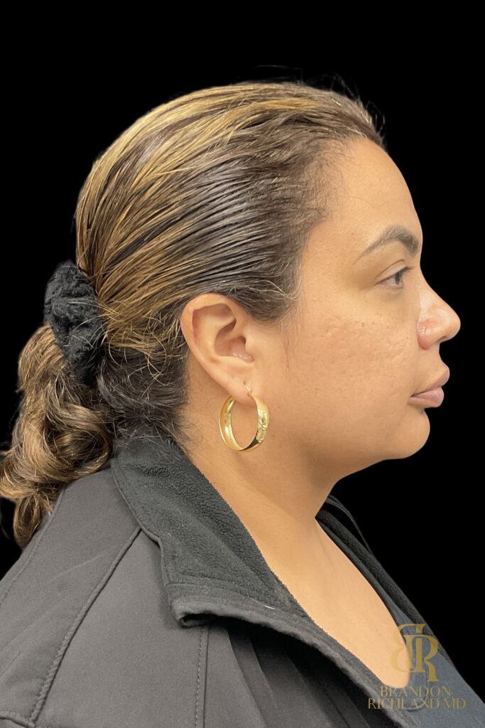 Chin Liposuction Before, Case #78890, view 3 — Dr. Brandon Richland, Newport Beach