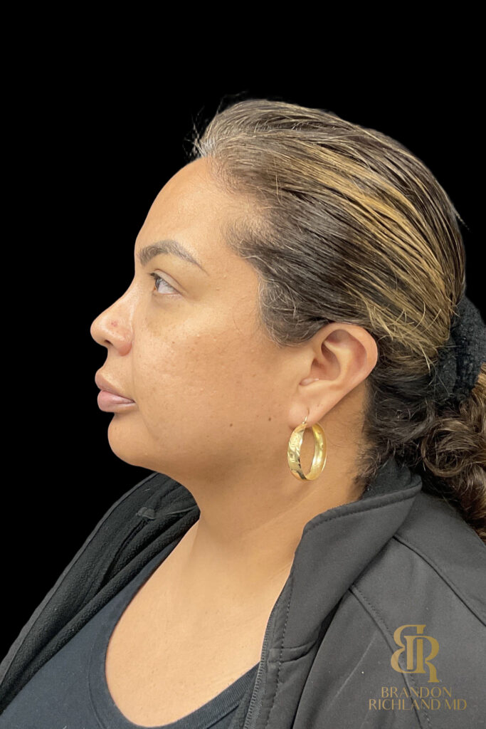 Chin Liposuction Before, Case #78890, view 5 — Dr. Brandon Richland, Newport Beach