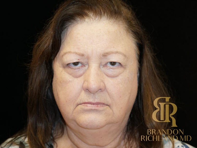 Blepharoplasty Before, Patient 01, view 1 — Dr. Brandon Richland, Newport Beach
