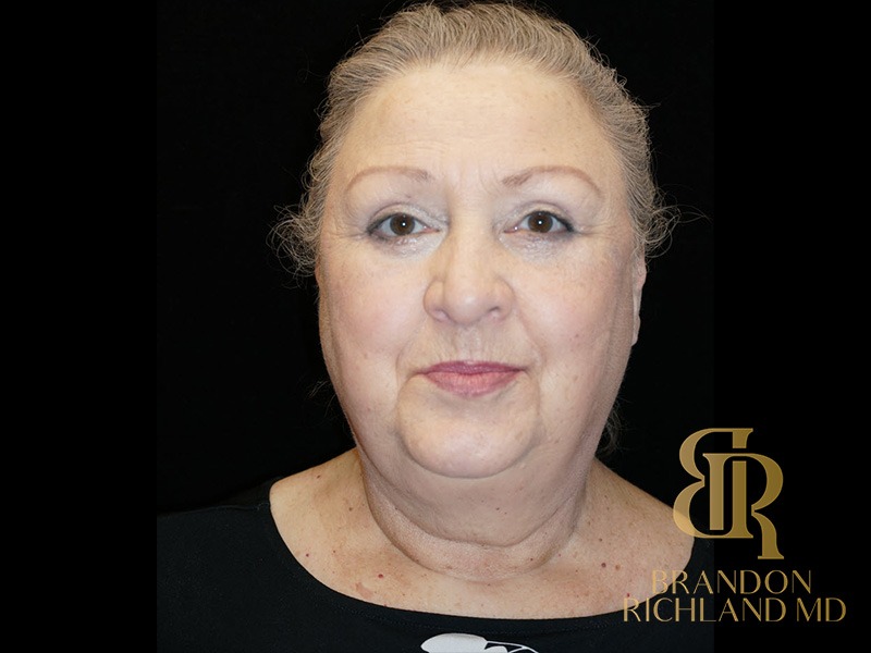 Blepharoplasty After, Patient 01, view 1 — Dr. Brandon Richland, Newport Beach