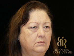 Blepharoplasty before and after, Patient 01 — Dr. Brandon Richland, Newport Beach