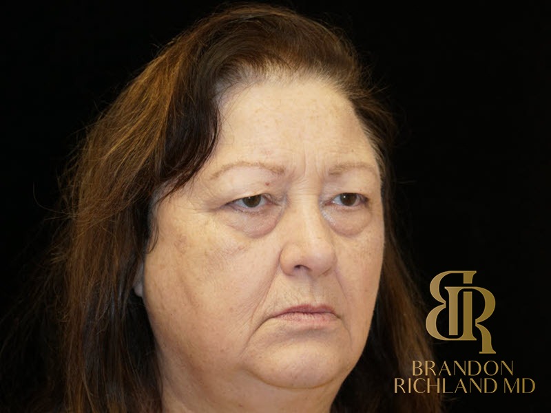 Blepharoplasty Before, Patient 01, view 2 — Dr. Brandon Richland, Newport Beach