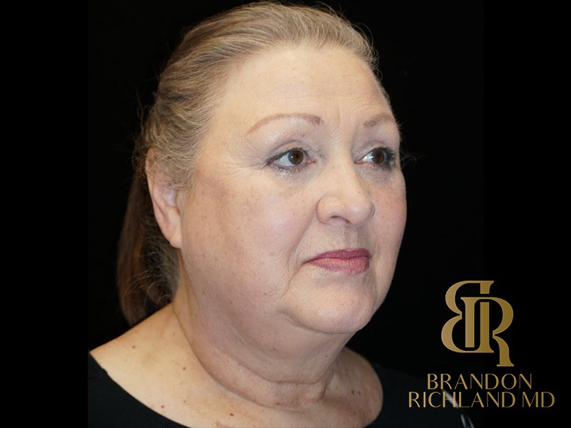 Blepharoplasty After, Patient 01, view 2 — Dr. Brandon Richland, Newport Beach