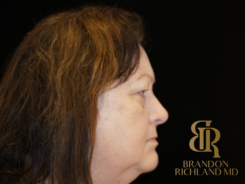 Blepharoplasty Before, Patient 01, view 3 — Dr. Brandon Richland, Newport Beach